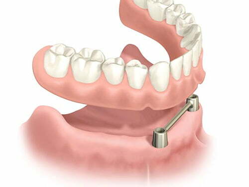 tekening-kunstgebit cosmetische tandheelkunde